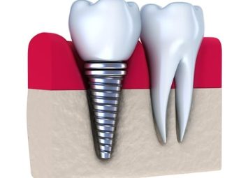 ایمپلنت چیست؟