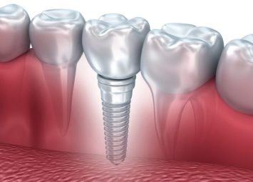 ایمپلنت دندان