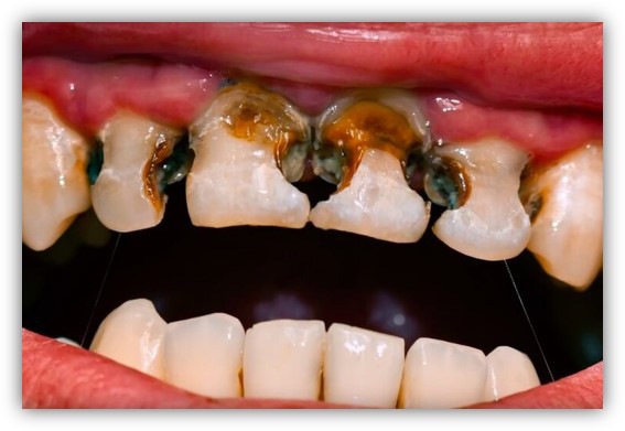 پوسیدگی دندان