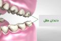 دندان عقل