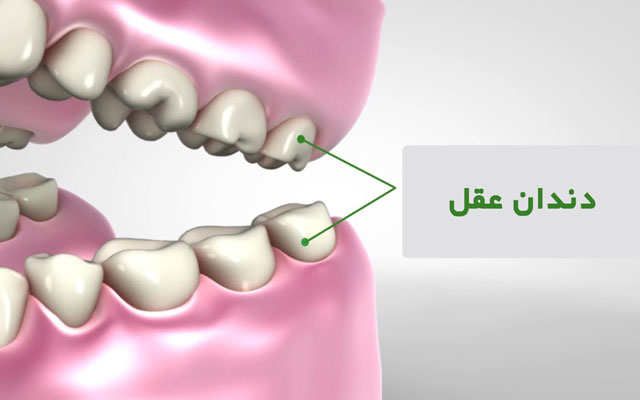 دندان عقل