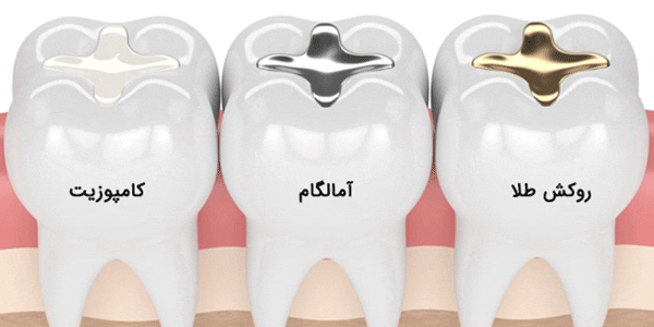 پر کردن دندان