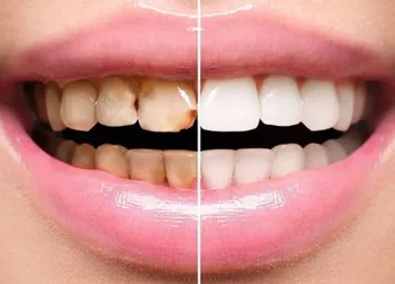 ونیرهای سرامیکی