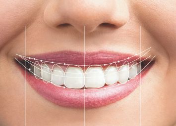 ترمیم شکل و فرم دندان