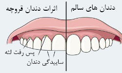دندان قروچه