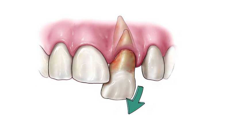 ترومای دندان