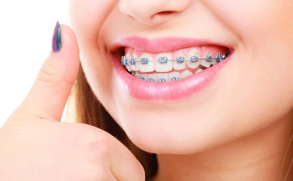 اورینگ‌های ارتودنسی