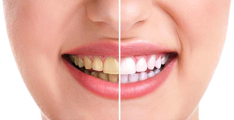روش های زیباسازی دندان
