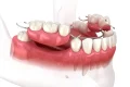 پروتز دندان