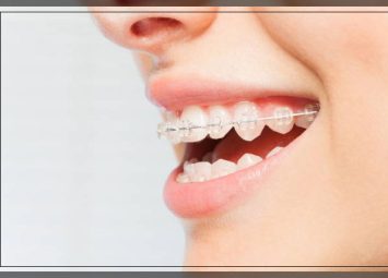 ارتودنسی سرامیکی