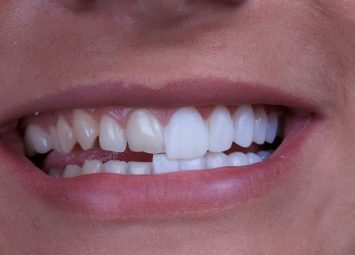 بلیچینگ بهتر است یا لمینت؟