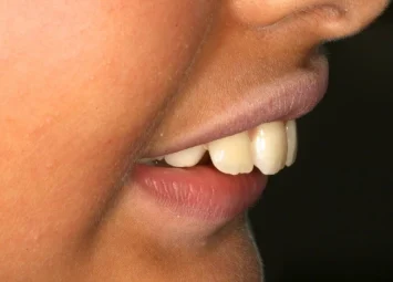 دندان خرگوشی