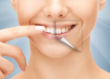 اصلاح لبخند با پروتز