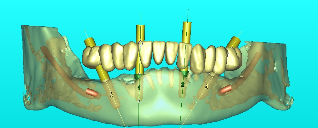 ایمپلنت CAD/CAM