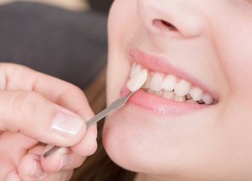 لمینت دندان در تهران