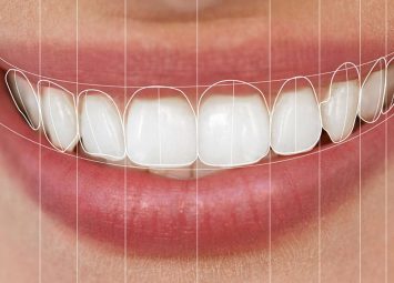 اصلاح طرح لبخند در جیحون