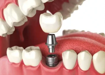 کاشت دندان در جیحون