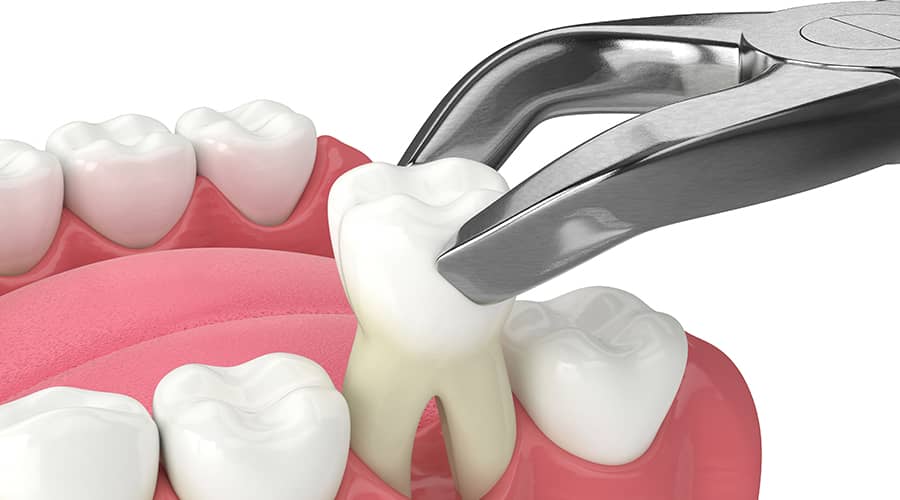 کشیدن دندان در جیحون