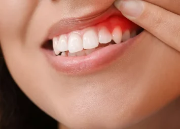 درمان لثه در جیحون