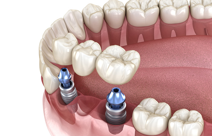 ایمپلنت فوری در جیحون