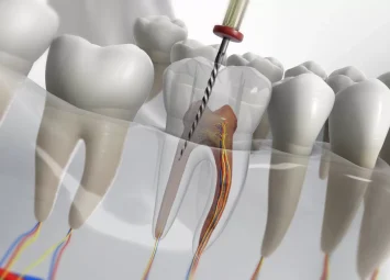 عصب کشی دندان در منطقه ۱۰