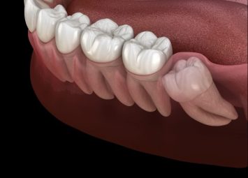 جراحی دندان نهفته در جیحون