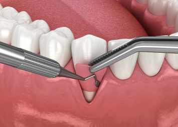 پیوند لثه در جیحون