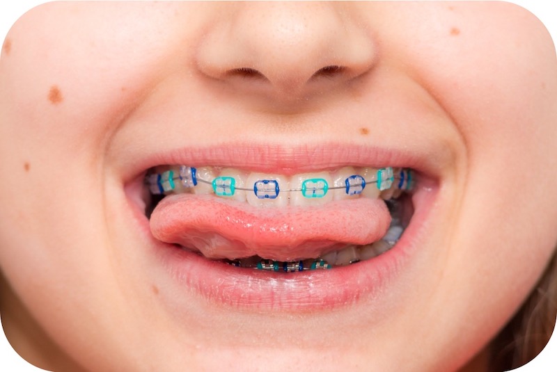 ارتودنسی کودکان در جیحون