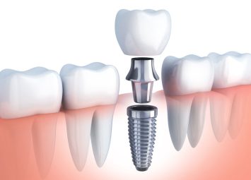ایمپلنت کودکان در جیحون