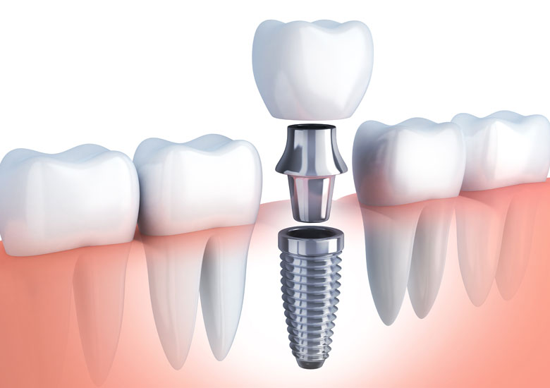 ایمپلنت کودکان در جیحون