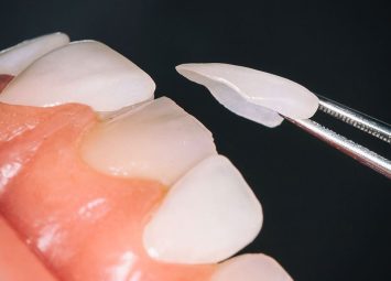 لمینت سرامیکی در جیحون